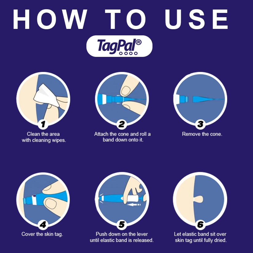 TagPal - Skin Tag Removal Kit